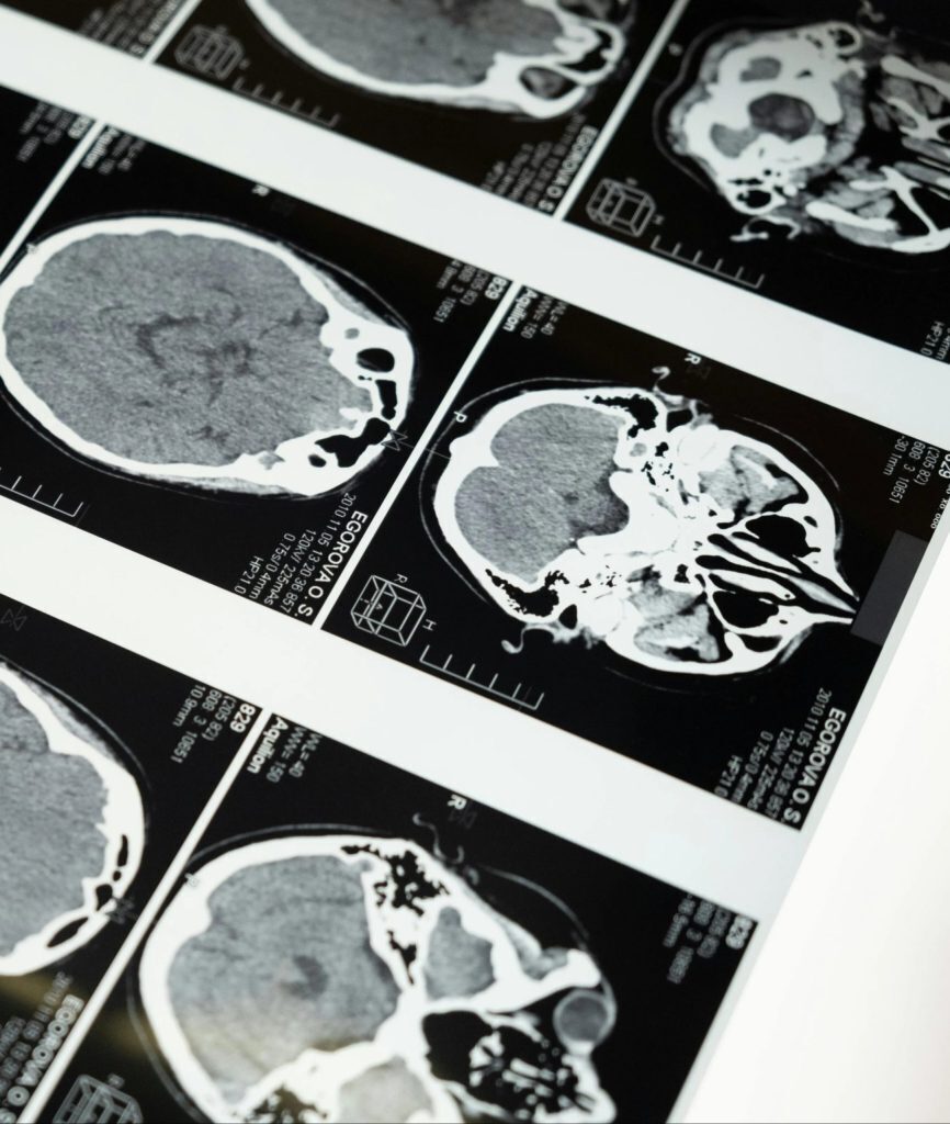 Stroke recovery care